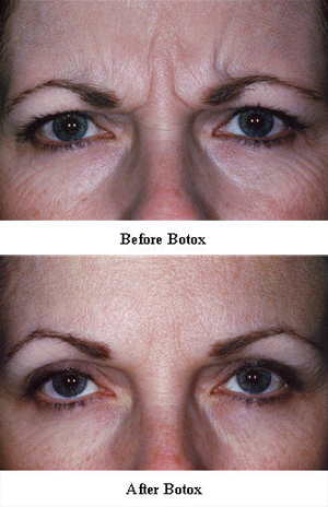 before-after-botox-2