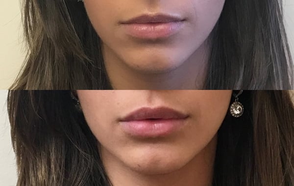 laura-before-and-after-lips-front-lips-only-th