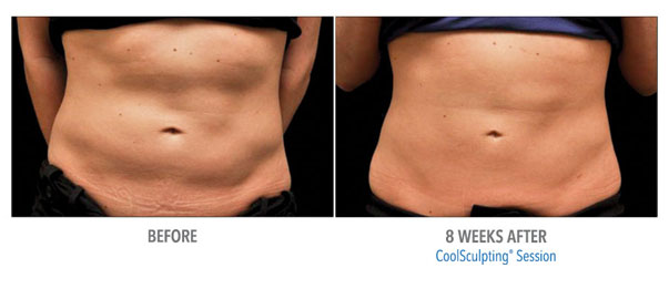 Coolsculpting® Before & Afters