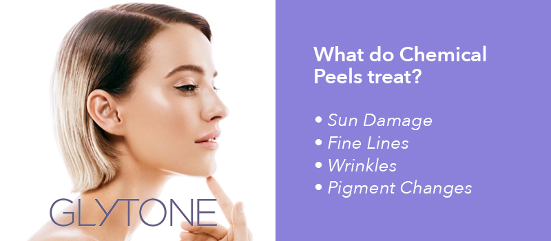 Chemical Peel