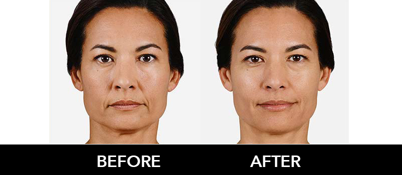 Dermal Filler