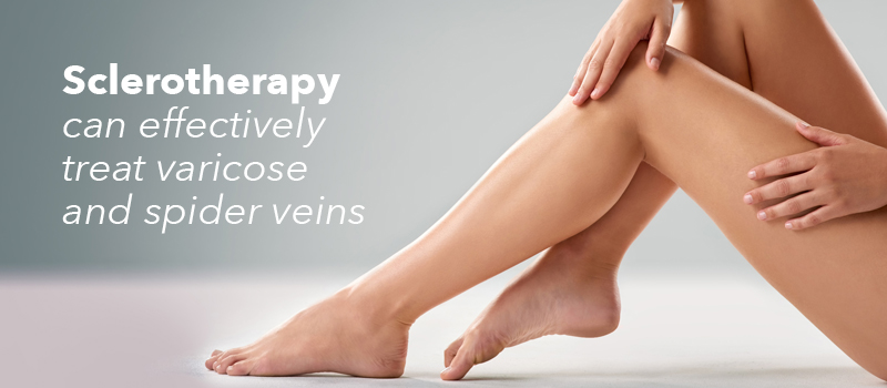 Sclerotherapy
