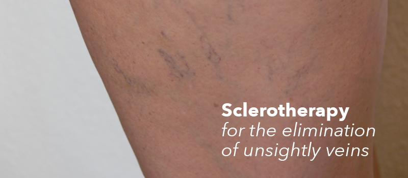 Sclerotherapy