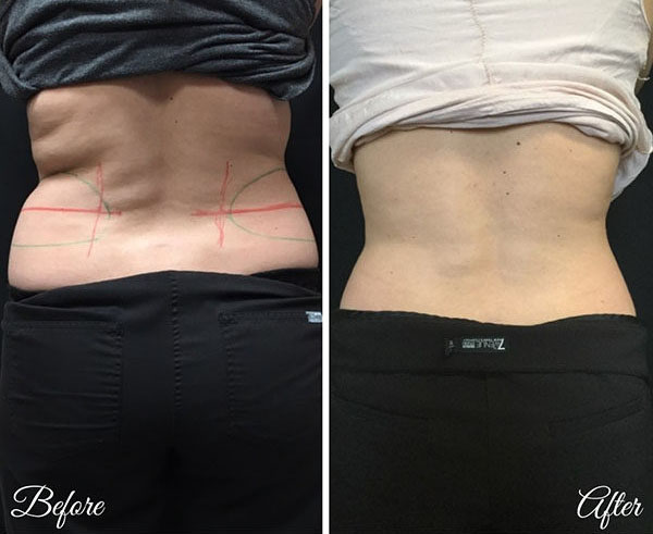 coolsculpting-3-600x660