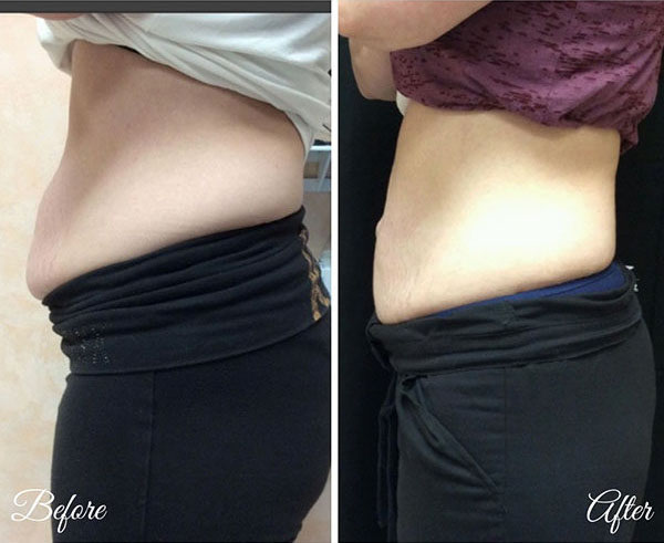 coolsculpting