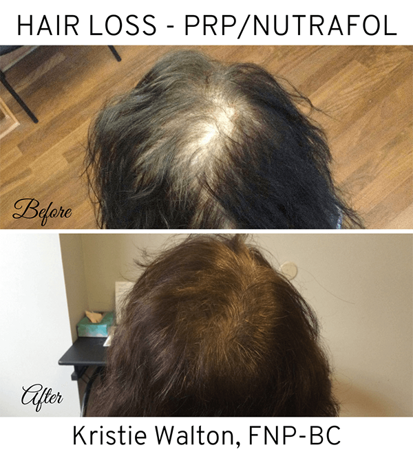 Hair Loss Metropolitan Dermatology