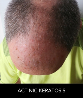 Actinic Keratosis