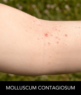 Molluscum Contagiosum