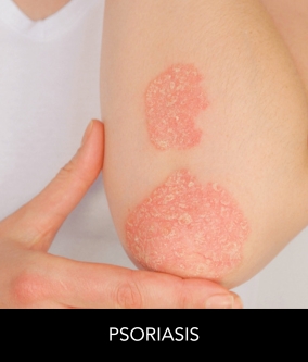 Psoriasis