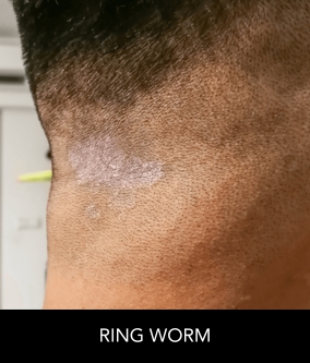 Ring Worm