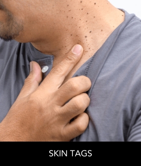 Skin Tags