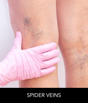 Spider Veins