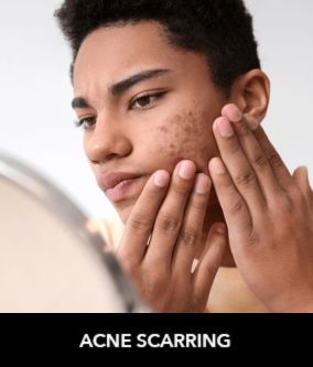 acne scarring
