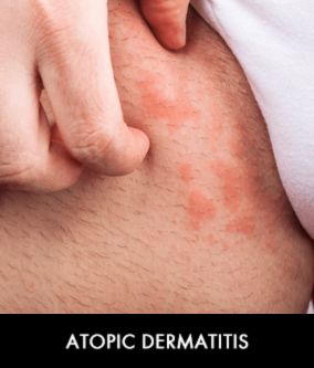 atopic dermatitis