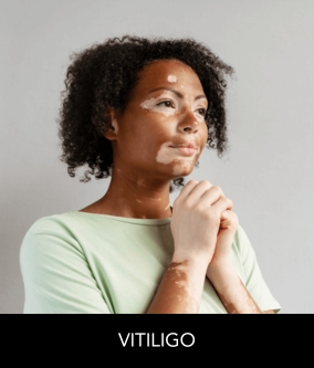 Vitiligo