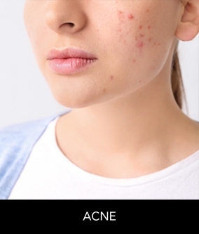 acne