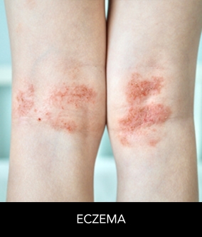 eczema