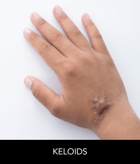 keloids