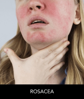 rosacea