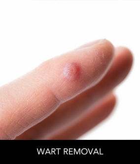 warts